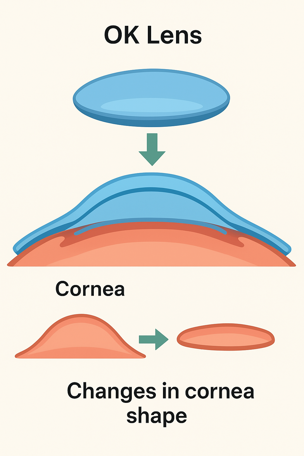 角膜塑形镜(OK镜)全面科普:你需要知道的一切